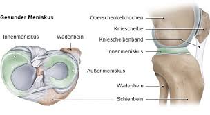 In dieser zeit heilt die quetschung in der regel folgenlos aus. Meniskusriss Und Meniskusschaden Gesundheitsinformation De