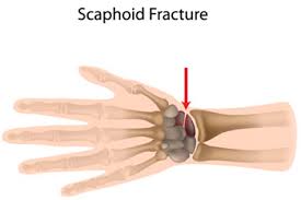 Therefore, a sprain would cause less pain than a fracture. Most Common Hand Wrist Injuries Bid Needham