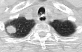 Ct criteria for hamartoma included a diameter of 2.5 cm or less, a smooth edge, and focal collections of fat or fat alternating with areas of calcification. Https D Nb Info 1191692663 34