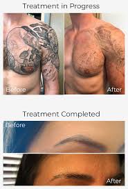 4.0 out of 5 stars. Why Tattoo Removal Tattooremovers Ink