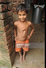 Boy born with parasitic twin has successful surgery