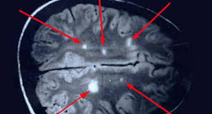 Przy podejrzeniu stwardnienia rozsianego przeprowadza się badanie głowy metodą rezonansu magnetycznego, a czasami również odpowiedniego odcinka kręgosłupa. Stwardnienie Rozsiane Stwardnienie Rozsiane Przyczyny Objawy Leczenie