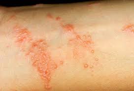 Poison Ivy Oak And Sumac Pictures Of Rashes Plants Poison Ivy Rash Poison Ivy Remedies Poison Ivy On Skin