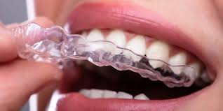Maka, jika warna karet behel yang anda pakai tampak indah, serasi dan bagus akan membuat tampilan behel gigi menjadi menarik. Info Behel Transparan Jenis Kisaran Harga Dan Plus Minusnya
