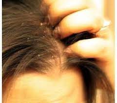 Pin On وصفات للتخلص من قشرة الشعر Dandruff