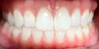 Having healthy gums isn't hard: Periodontal Gum Disease Dentist In Reston Va Reston Sunrise Dentistry Of Reston