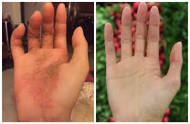 A natural way to cure eczema is epo(evening primrose oil) capsule. How To Change Your Diet To Heal Eczema Naturally By Antonelle Cara Better Humans Medium