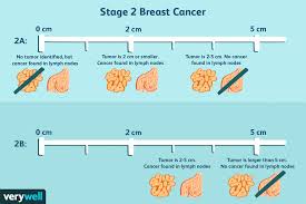 But hearing the words can still be scary. Stage 2 Breast Cancer Diagnosis Treatment Survival