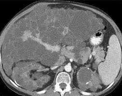 Polycystic Liver Disease Multimodality Imaging For Complications And Transplant Evaluation Radiographics