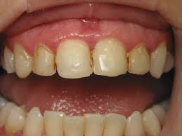 This includes tainted teeth, crackedteeth. Veneers Vs Cosmetic Bonding Which Is Right For You Stovall Cheng Dds Pllc