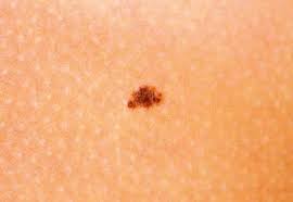 Check spelling or type a new query. Common Benign Growths