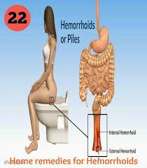 22 Home Remedies For Hemorrhoids Home Remedies For Hemorrhoids Hemorrhoids Treatment Home Remedies