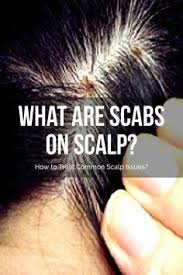 What Are Scabs On Scalp How To Treat Common Scalp Issues Hairlosswomenremedies Dry Scalp Remedy Thick Hair Remedies Scalp Scabs