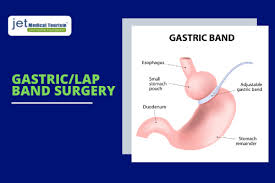 Weight Loss Surgery Cost In Mexico Jet Medical Tourism