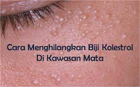 See more of cara hilangkan ketuat kutil biji kolestrol on facebook. Cara Menghilangkan Biji Kolesterol Di Muka Jarimenulis Com