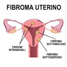 Ou seja, um fibroma uterino, nada mais é do que um mioma uterino. Fibroma Dell Utero Formazioni Tumorali Benigne Issalute