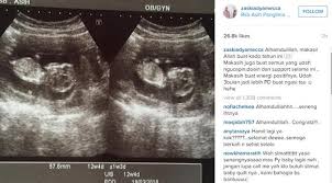 Obat aborsi cytotec 200 mcg solusi tepat untuk cara menggugurkan kandungan 1 2 3 4 5 6 7 8 bulan secara alami dan ampuh tanpa gagal. Pamer Hasil Usg Kehamilan Zaskia Adya Mecca Masuki Usia 3 Bulan Showbiz Liputan6 Com