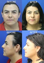 Check out this great FFS before and after including scalp advancement and  forehead contouring.