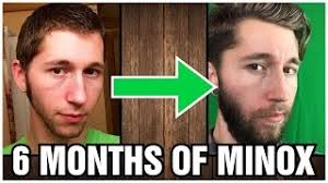 I use to have a patchy beard,and with just 1 month of application i already have noticed a huge change. Minoxidil Beard Months 1 6 Youtube