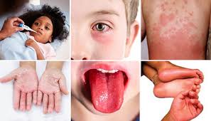The new way COVID-19 might be affecting kids | Children's Wisconsin