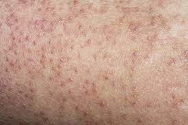 Keratosis Pilaris Nhs