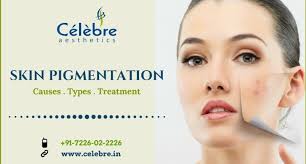 So, what exactly is skin pigmentation? Skin Pigmentation Causes Types And Treatment By Dr Siddharth Sakhiya Linkedin