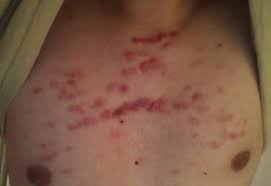 Check spelling or type a new query. How Do I Get Rid Of Keloid Acne Scars On My Chest Scar Treatments Acne Org