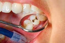 Sonhar Com Dente Cariado O Que Significa Todos Os Resultados Na vida real, um dente sangrando é sinal de que o dente está sonhar arrancando dente pode representar que você sofrerá alguns prejuízos econômicos, como se estivessem extraindo dinheiro de você. sonhar com dente cariado o que