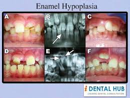That's because they're both defects, often caused by genetic predispositions, that affect the. Enamel Hypoplasia Is Common Disorder Of Human Teeth Enamel Hypoplasia Symptons Includes Roughened Suface With Dicreet Pitting Ena Dentist Dental Humor Dental