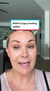 As most of you know, I had MOHS Surgery recently to remove a basal cell  carcinoma