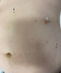 Check spelling or type a new query. Needlescopic Surgery For Large Umbilical Hernia In A Patient With Morbid Obesity Using Intraperitoneal Onlay Mesh With Fascial Defect Closure A Case Report Surgical Case Reports Full Text