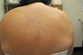 Optimize your health today we're … Tattoo Removal Before After Images
