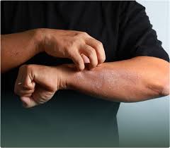 Image result for Dry Skin