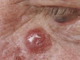 Their shape and color are less. Merkel Cell Carcinoma Dermnet Nz
