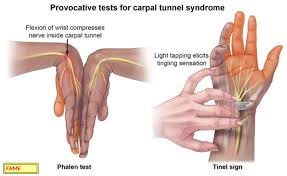 Image result for Carpal Compression Test
