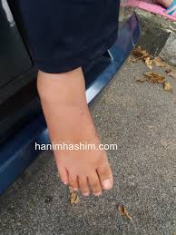 Bila kaki terseliuh, biasanya berlaku kecederaan pada ligamen di sendi pergelangan kaki. Petua Melegakan Bengkak Akibat Gigitan Serangga Nukilan Budak Flat