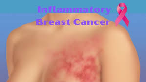 Image result for Inflammatory breast cancer