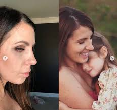 Amazing experience for secondary rhinoplasty!