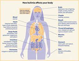 Bulimia Nervosa - Helpguide.org