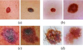 Breast cancer is the second most common cancer found in women — after skin cancer — but that doesn't mean men aren't at risk as well. Melanoma Images A C Simple Images And B D Dermatological Images Download Scientific Diagram