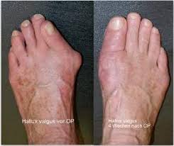 Als letzte option wird bei bereits stark verformten zehen meist eine operation durchgeführt. Die Light Op Bei Hallux Valgus Jameda