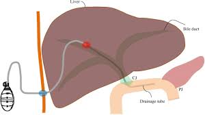 Check spelling or type a new query. Retrograde Installation Of Percutaneous Transhepatic Negative Pressure Biliary Drainage Stabilizes Pancreaticojejunostomy After Pancreaticoduodenectomy A Retrospective Cohort Study World Journal Of Surgical Oncology Full Text