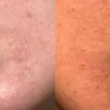 Sometimes, they are accompanied by inflammation too. Acne Closed Comedones Cluster In Chin All Around My Mouth After Stopping Birth Control More Info In Comments Skincareaddiction