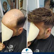 · ** sfsl (super fine swiss lace) . Protesi Capelli Come Scegliere L Impianto Giusto Per Te Mondo Parrucche