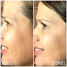 Therefore, the procedure must be repeated. Antes Y Despues Botox Lola Centro De Medicina Estetica Facebook