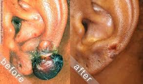 Image result for Keloid