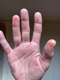 Maybe you would like to learn more about one of these? Page 2 What Are These Orange Stains That Have Appeared On My Hands Overnight Gransnet