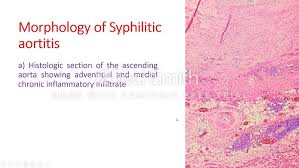 Image result for Cardiovascular Syphilis