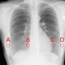 Pdf Analysis Of Radiograph And Detection Of Cardiomegaly