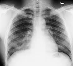 Image result for Pulmonary Contusion